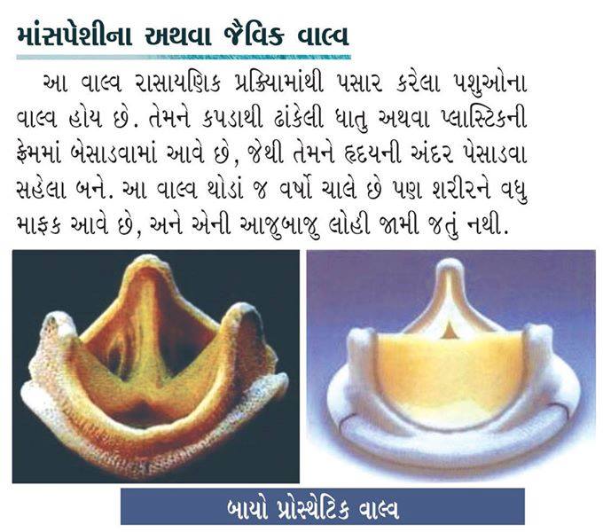 માશપેિશિના અથવા જૈવિક વાલ્વ. 