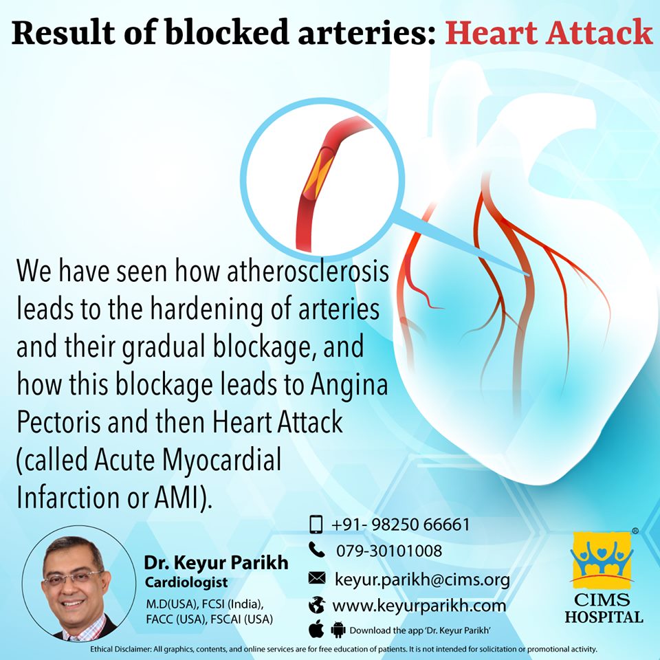 Result of blocked arteries: Heart Attack
